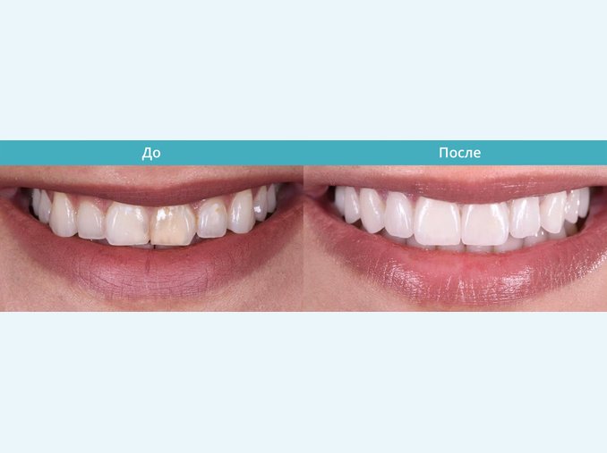 клиновидный дефект зубов отбеливание зубов